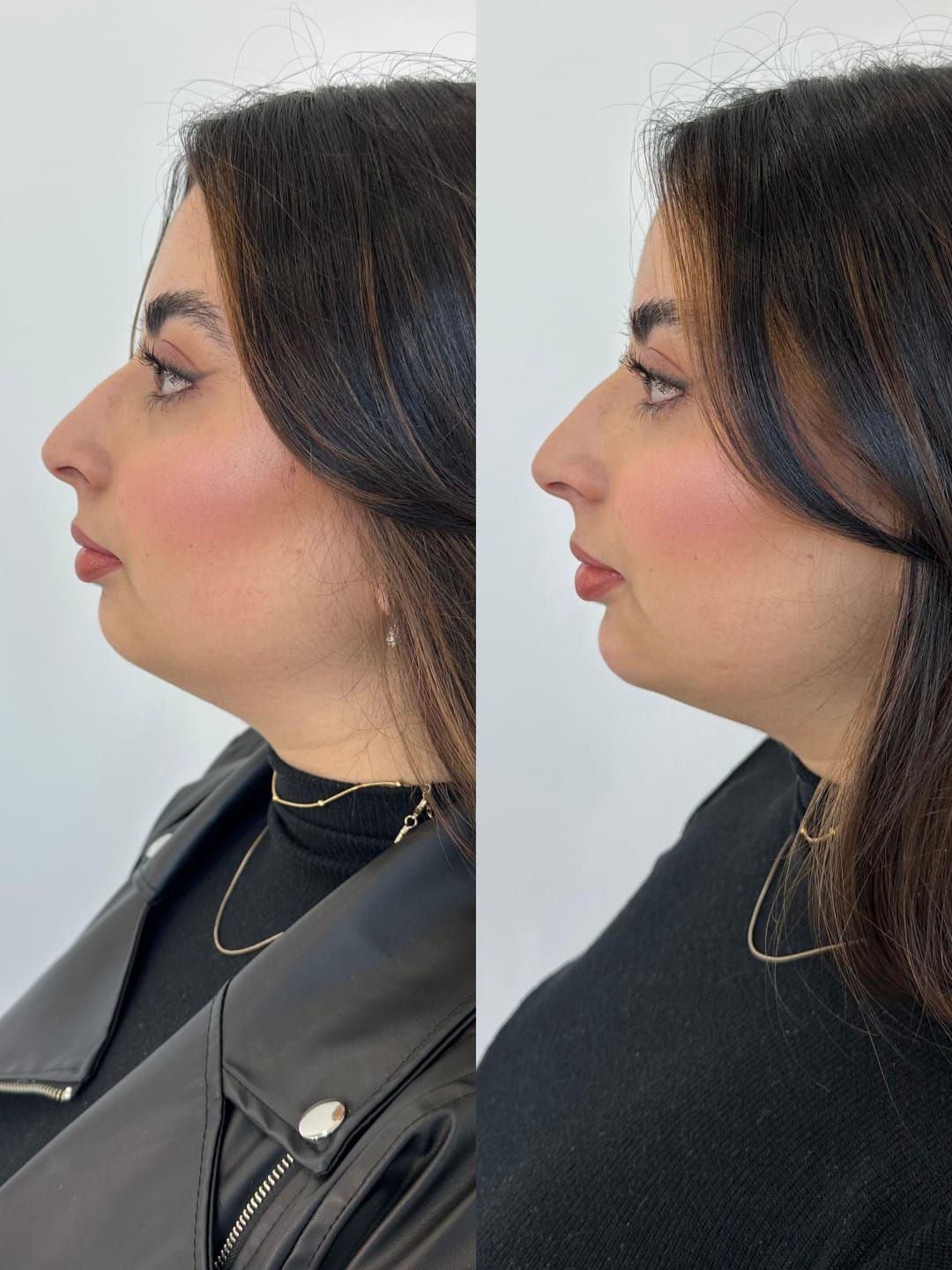 Par antes e depois, lado a lado, do rosto de perfil da mesma paciente. À esquerda o antes, à direita o depois, no mesmo enquadramento.