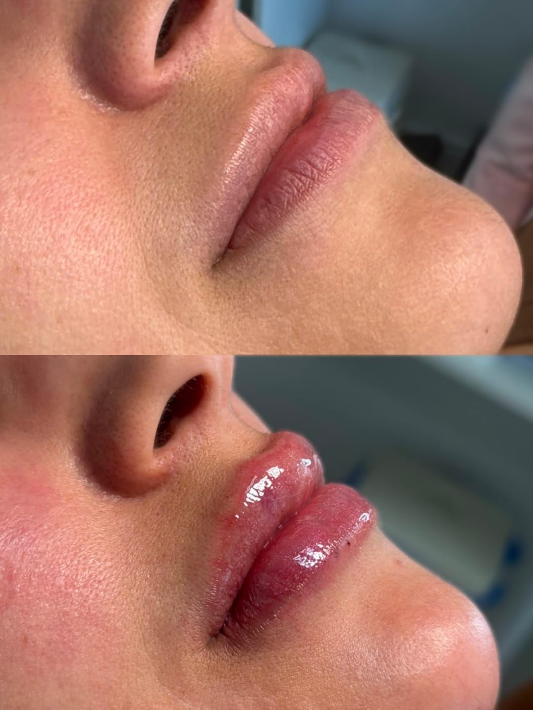 Par antes e depois, um acima do outro, dos lábios da mesma paciente em close. Acima o antes, abaixo o depois, no mesmo enquadramento.